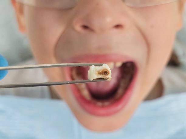 Best Emergency Treatment for Toothache in Anderson, SC